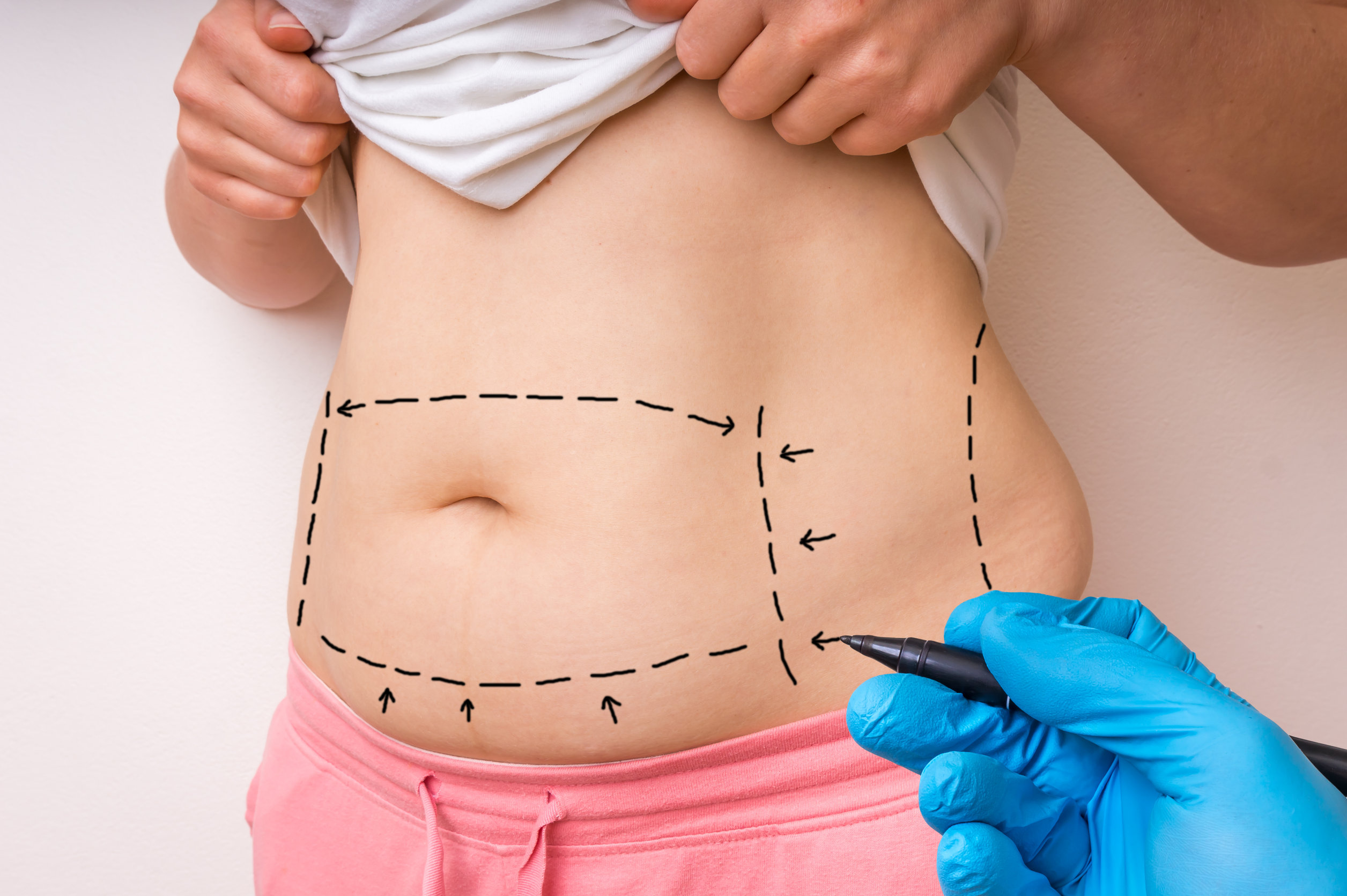 Liposuction (Body Contouring by Unwanted Fats Removal)